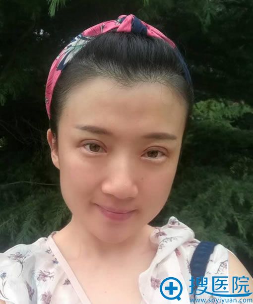 找北京齐永乐做双眼皮修复30天后 找北京齐永乐做双眼皮修复30天后