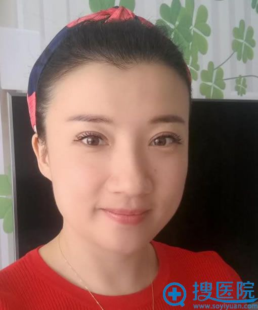 做完双眼皮和开眼角修复2个月后 做完双眼皮和开眼角修复2个月后