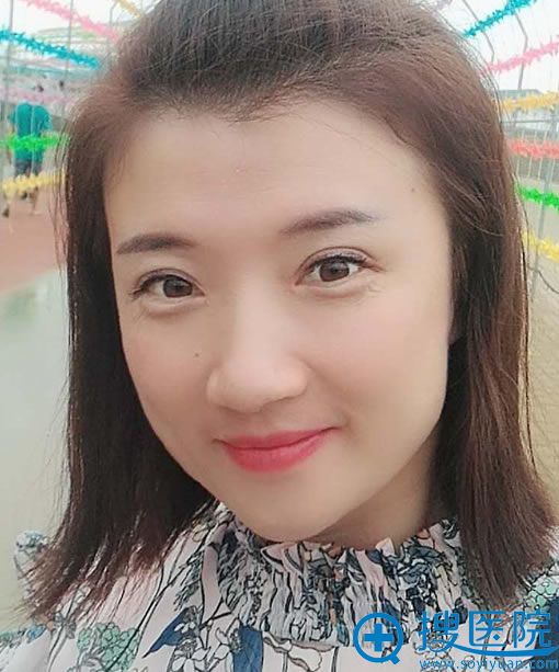 埋线双眼皮失败找齐永乐修复3个月后 埋线双眼皮失败找齐永乐修复3个月后