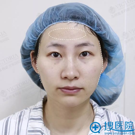苏州维多利亚潘杰自体脂肪填充案例告诉你不磨骨能改善颧骨突出