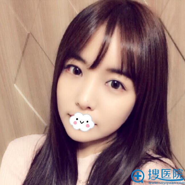 到正规医院扬州美贝尔李志金处做假体隆鼻效果好吗?