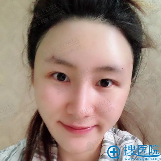 <!--<i data=20240710 data-id=12122></i>-->潘杰脂肪填充案例即刻效果 <!--<i data=20240710 data-id=12122></i>-->潘杰脂肪填充案例即刻效果