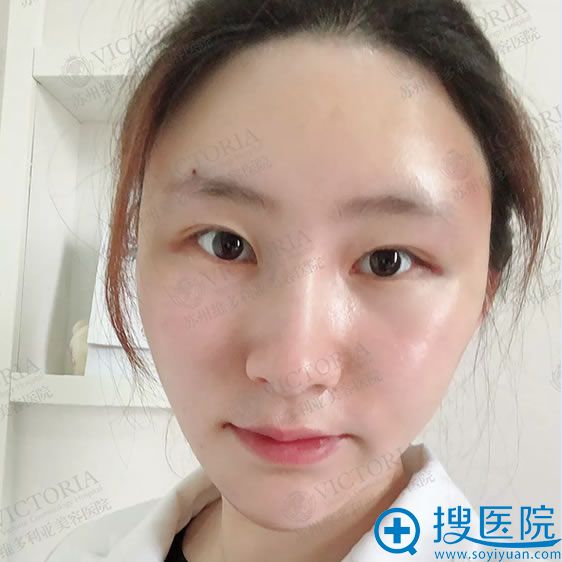 做完自体脂肪填充术后1天效果 做完自体脂肪填充术后1天效果