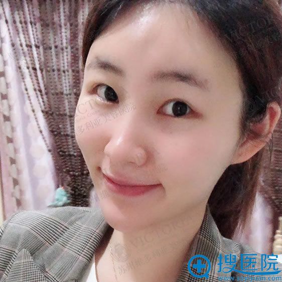 <!--<i data=20240710 data-id=12122></i>-->潘杰自体脂肪填充案例 <!--<i data=20240710 data-id=12122></i>-->潘杰自体脂肪填充案例