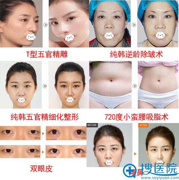 <!--<i data=20240710 data-id=8411></i>-->双眼皮、隆鼻效果前后对比 <!--<i data=20240710 data-id=8411></i>-->双眼皮、隆鼻效果前后对比