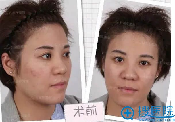 在这里叙述下我让石家庄美莱的姜涛做全脸自体脂肪填充的经历