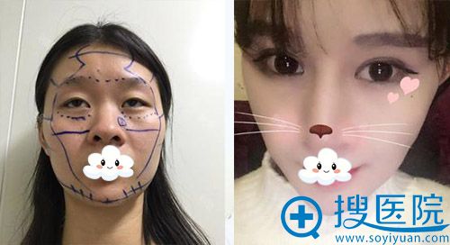 成都素美郭英宁给我做了双眼皮和面部脂肪填充后,都说我变美了