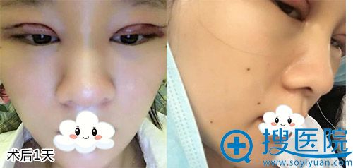 <!--<i data=20240710 data-id=12923></i>-->双眼皮和面部填充案例 <!--<i data=20240710 data-id=12923></i>-->双眼皮和面部填充案例