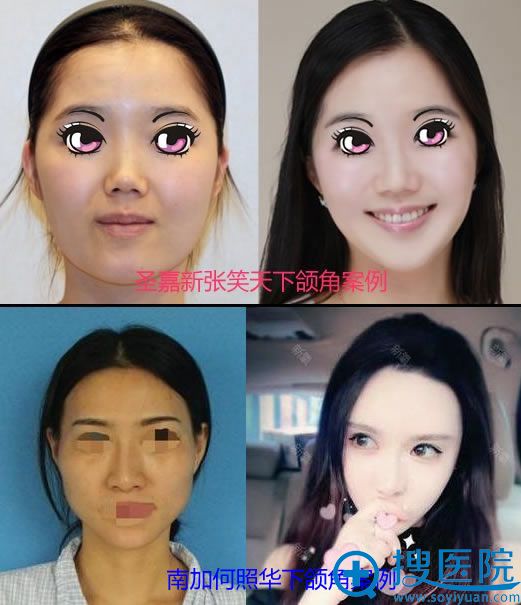 观摩了北京南加何照华和圣嘉新张笑天磨骨案例找何照华做颧骨