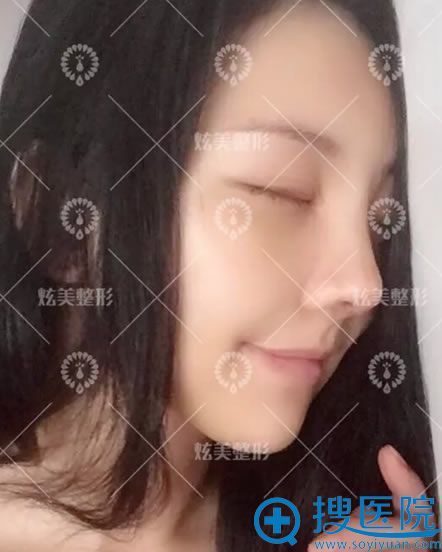 选择<!--<i data=20240710 data-id=12618></i>-->马群做隆鼻7天效果 选择<!--<i data=20240710 data-id=12618></i>-->马群做隆鼻7天效果
