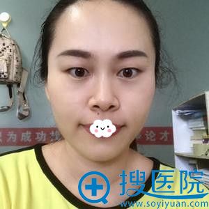 深圳江南春天双眼皮真人案例 深圳江南春天双眼皮真人案例