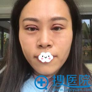 深圳江南春天李钢韩式微创双眼皮效果 深圳江南春天李钢韩式微创双眼皮效果
