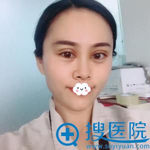 深圳江南春天李钢韩式微创双眼皮案例 深圳江南春天李钢韩式微创双眼皮案例