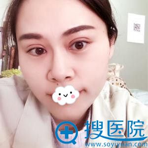深圳江南春天李钢全切双眼皮+开眼角效果 深圳江南春天李钢全切双眼皮+开眼角效果