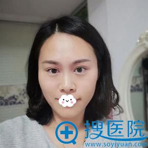 深圳江南春天李钢眼综合术后恢复效果 深圳江南春天李钢眼综合术后恢复效果