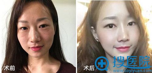 分享我在西安雁塔女子医院做自体脂肪面部填充30天效果