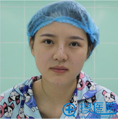 之前做的线雕隆鼻效果不好这次找长沙希美蒋松林做了鼻综合隆鼻