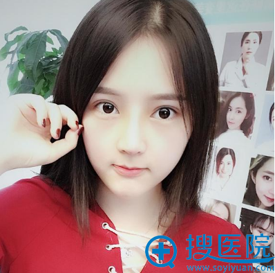 长沙希美整形医院蒋松林隆鼻术后七天恢复图片 长沙希美整形医院蒋松林隆鼻术后七天恢复图片