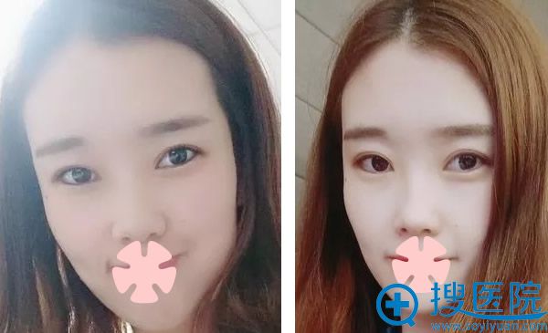<!--<i data=20240710 data-id=9374></i>-->割双眼皮三个月后 <!--<i data=20240710 data-id=9374></i>-->割双眼皮三个月后