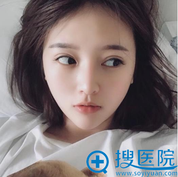 长沙希美医疗美容整形医院蒋松林院长鼻综合隆鼻案例术后三个月效果图 长沙希美医疗美容整形医院蒋松林院长鼻综合隆鼻案例术后三个月效果图