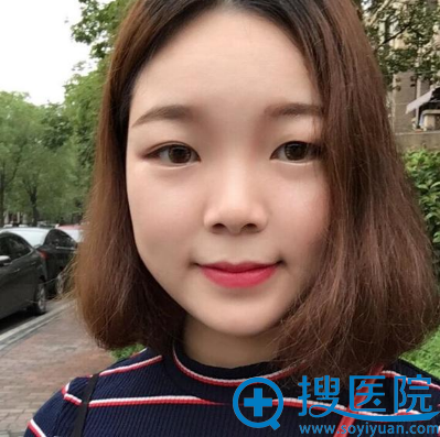 眼睛一单一双没办法找上海美莱何祥龙医生做了切开双眼皮来改善