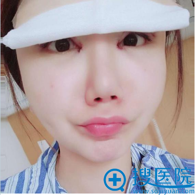 找上海美莱杜园园做完眼睛修复术后天图片 找上海美莱杜园园做完眼睛修复术后天图片