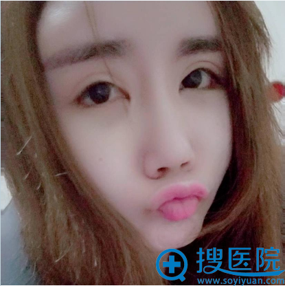 来上海美莱整形医院做双眼皮修复前的照片 来上海美莱整形医院做双眼皮修复前的照片