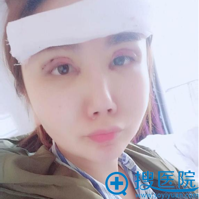 上海美莱双眼皮失败修复术后三天恢复情况 上海美莱双眼皮失败修复术后三天恢复情况