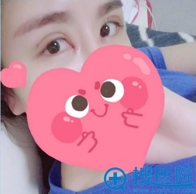 上海美莱杜园园双眼皮失败修复术后十天图片 上海美莱杜园园双眼皮失败修复术后十天图片