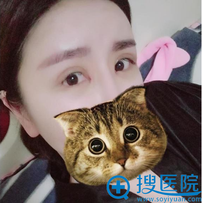 上海美莱杜园园眼睛修复术后一个月效果图 上海美莱杜园园眼睛修复术后一个月效果图