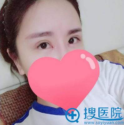 上海美莱整形医院杜园园双眼皮修复案例术后一个月效果图 上海美莱整形医院杜园园双眼皮修复案例术后一个月效果图