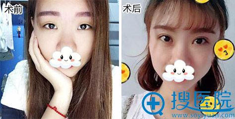 <!--<i data=20240710 data-id=9128></i>-->孟院长双眼皮案例 <!--<i data=20240710 data-id=9128></i>-->孟院长双眼皮案例