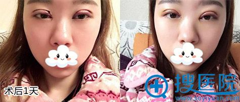 <!--<i data=20240710 data-id=9128></i>-->孟院长双眼皮案例 <!--<i data=20240710 data-id=9128></i>-->孟院长双眼皮案例
