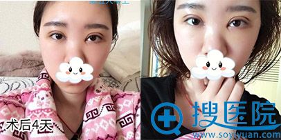 <!--<i data=20240710 data-id=9128></i>-->孟院长双眼皮案例 <!--<i data=20240710 data-id=9128></i>-->孟院长双眼皮案例