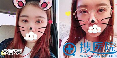 <!--<i data=20240710 data-id=9128></i>-->孟院长双眼皮案例 <!--<i data=20240710 data-id=9128></i>-->孟院长双眼皮案例
