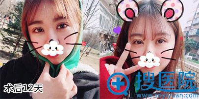 <!--<i data=20240710 data-id=9128></i>-->孟院长双眼皮案例 <!--<i data=20240710 data-id=9128></i>-->孟院长双眼皮案例
