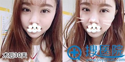 <!--<i data=20240710 data-id=9128></i>-->孟院长双眼皮案例 <!--<i data=20240710 data-id=9128></i>-->孟院长双眼皮案例