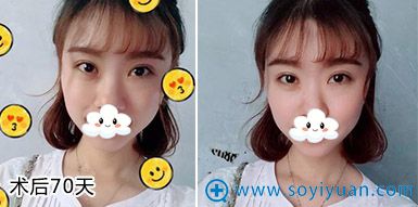 <!--<i data=20240710 data-id=9128></i>-->孟院长双眼皮案例 <!--<i data=20240710 data-id=9128></i>-->孟院长双眼皮案例