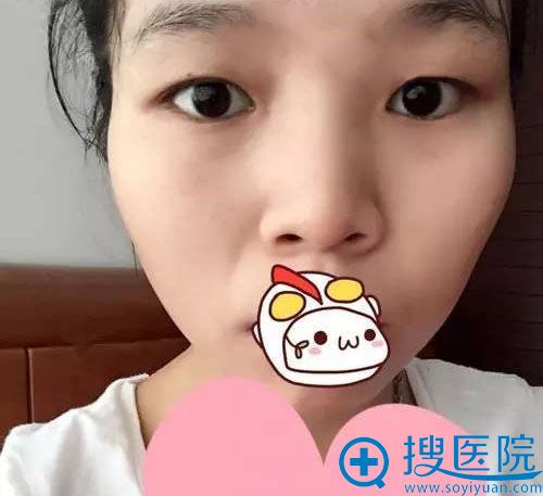 新疆乌鲁木齐华美埋线双眼皮效果怎么样 新疆乌鲁木齐华美埋线双眼皮效果怎么样