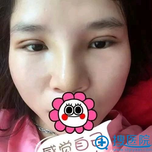 新疆乌鲁木齐华美埋线双眼皮术后效果 新疆乌鲁木齐华美埋线双眼皮术后效果