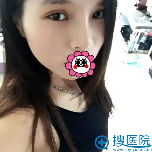 新疆乌鲁木齐华美李艳霞埋线双眼皮真人案例 新疆乌鲁木齐华美李艳霞埋线双眼皮真人案例