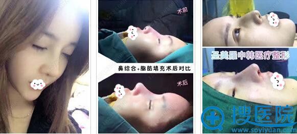 乐山圣美罗假体隆鼻案例效果对比 乐山圣美罗假体隆鼻案例效果对比