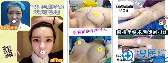 乐山圣美罗自体脂肪面部填充效果对比 乐山圣美罗自体脂肪面部填充效果对比