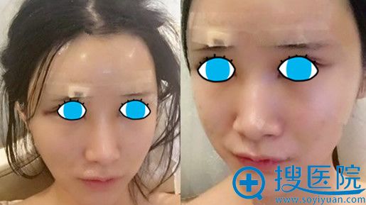 郭新志主任自体脂肪面部填充第1天照片 郭新志主任自体脂肪面部填充第1天照片