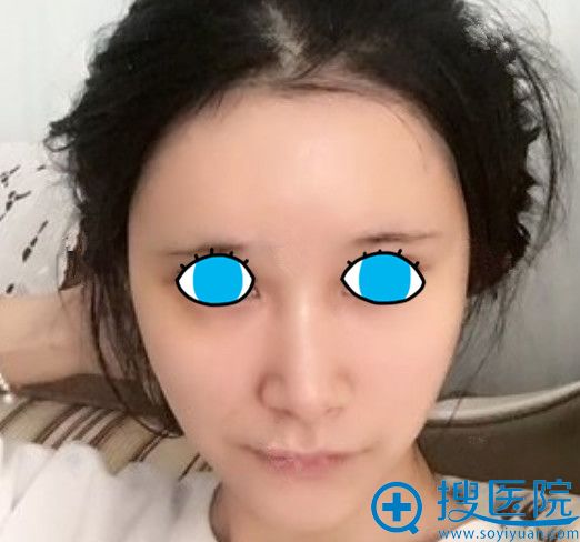 <!--<i data=20240710 data-id=11457></i>-->整形做自体脂肪填充面部第13天恢复图 <!--<i data=20240710 data-id=11457></i>-->整形做自体脂肪填充面部第13天恢复图