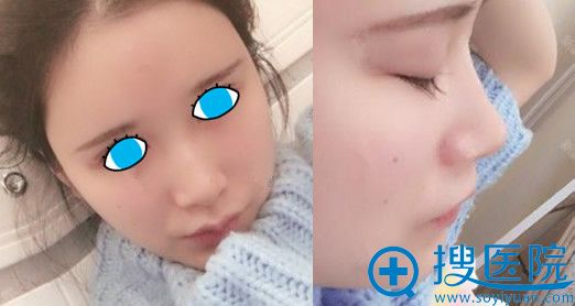 在<!--<i data=20240710 data-id=11457></i>-->整形做面部自体脂肪填充第63天效果图展示 在<!--<i data=20240710 data-id=11457></i>-->整形做面部自体脂肪填充第63天效果图展示