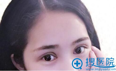 滨州华美全切双眼皮术后效果 滨州华美全切双眼皮术后效果