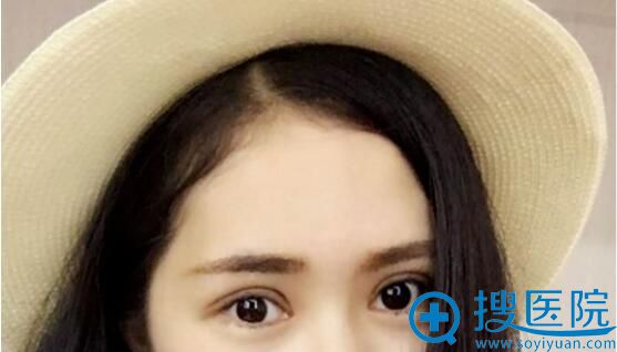 滨州华美切开双眼皮真人案例 滨州华美切开双眼皮真人案例