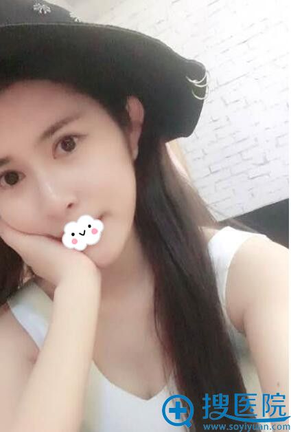 滨州华美张洪星双眼皮效果怎么样 滨州华美张洪星双眼皮效果怎么样