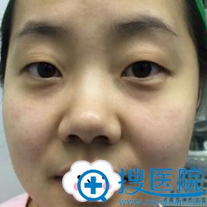 <!--<i data=20240710 data-id=12341></i>-->姚盛雷双眼皮真人案例 <!--<i data=20240710 data-id=12341></i>-->姚盛雷双眼皮真人案例